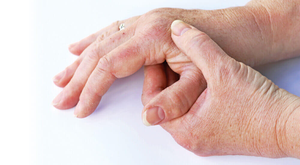 median fødsel læser Artrose i hænderne