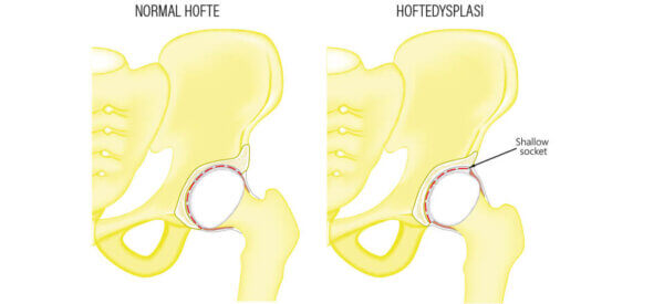 Hoftedysplasi